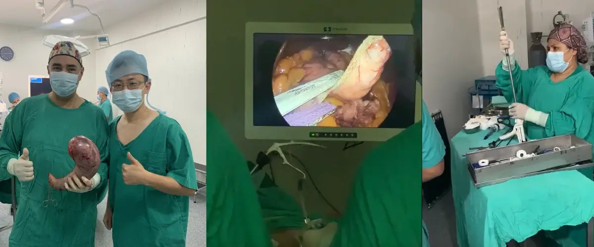 A successful sleeve gastrectomy in Peru using Miconvey endoscopic linear stapler 