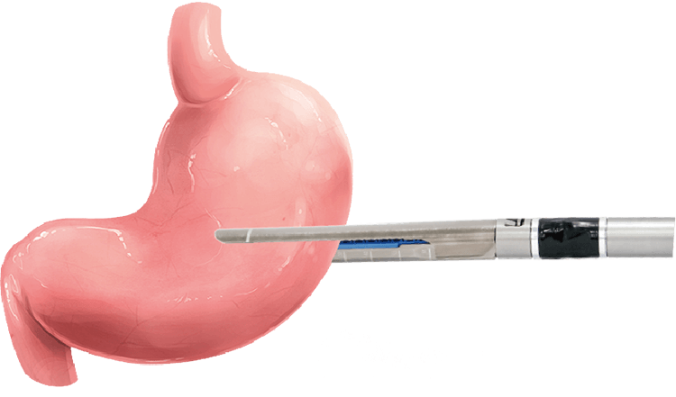 Tissue pre-compression